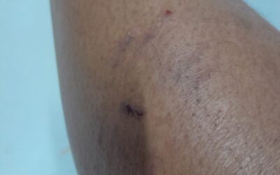 Homem denuncia que foi mordido por cachorro de rua